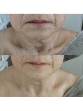 ビーユー(Be.you)/リフトアップコース