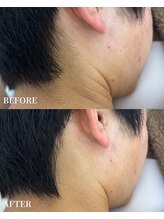 エース(ACE.)/うなじ脱毛で清潔感・印象UP☆