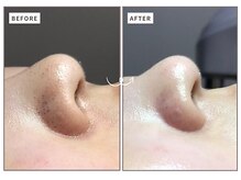 ルペルル(Le’perle。)の雰囲気（毛穴エクストラクションの驚きの効果!!本気の毛穴黒ずみ除去！！）
