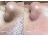 【期間限定】毛穴の大掃除＆水分チャージで接近OKな美鼻へ