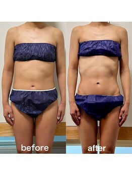 ソラ(sola*)/痩身全身