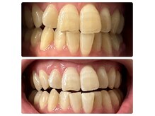 話題の美歯口ホワイトニング。口臭、虫歯予防にもオススメ