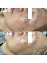 コリー(Kolly)/シミケア