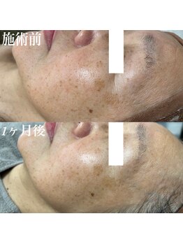 コリー(Kolly)/シミケア