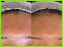 ハーブピーリング 名古屋/肌改善