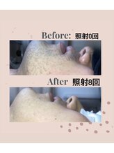 マオ(mao)/☆8回Before→after☆