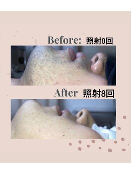 マオ(mao)/☆8回Before→after☆