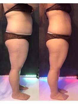 サニー(SUNNIE)/脂肪冷却痩身8カップ［5回］