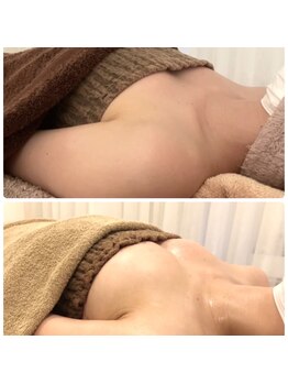 サロン ド チョコ(SALON DU CHOCO)/【バストアップ】症例