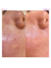 プリュスマイル(+Smile.)/フェイシャルWax