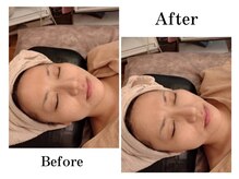 トータルエステティック ライム(lime)/何度も触りたくなるお肌毛穴ケア