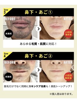 サロン ド ヤマト/ヒゲ脱毛(Before/After)