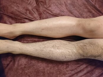 ルテラ(Lutella)の写真/【メンズワックス脱毛】気になる『脇・胸・足・ひげ』もしっかりケア◎施術後はキレイを実感！