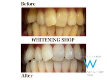 ホワイトニングショップ 甲賀店/Before&After『ホワイトニング』