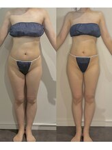 カルナ(CARNA)/【痩身】セルライトゼロ 2