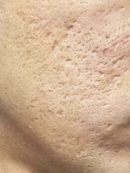 ソルエユニーク(Le seul et unique)の写真/【最新美容機器フェイシャル¥15400】毛穴の開きや黒ずみにお悩みの方に!キメを整えてツルんとしたお肌へ♪