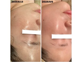 サロン リア(Salon Li’a)/【シミケア70コース】お客様の声