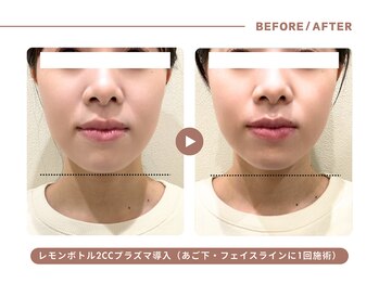 イエス マイサロン(yes My Salon)/レモンボトル施術例