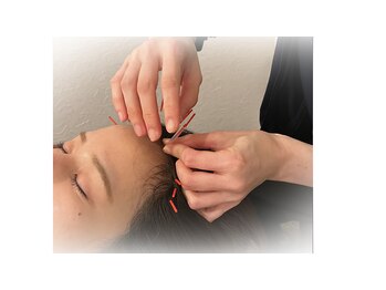 なつめ鍼灸ボディケアサロンの写真/分け目 広がっていませんか？髪が気になりはじめた大人女性の為の頭皮鍼＊【髪ふっくら育毛鍼 45分3500円】