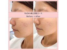 ディアメ(Diame)/肌質改善お任せください＾＾