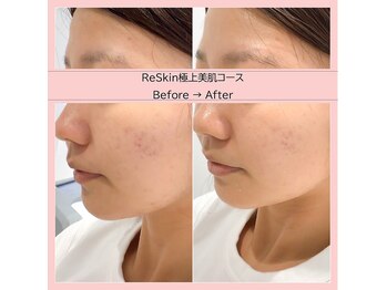 ディアメ(Diame)/肌質改善お任せください＾＾