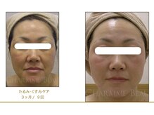 ベルメイク(BELLE MAKE)/ビフォーアフター