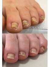 ウェルズユキ(well's yuki)/角質増殖/厚みのある爪