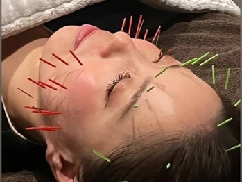 アンブル(Ambre)の写真/劇的小顔術★【小顔矯正+美容鍼】の組合せで理想の美顔へ♪カウンセリング重視なので、初めての方にも◎