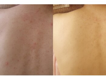 れふぇるん 足利店/背中ニキビケア 2ヶ月