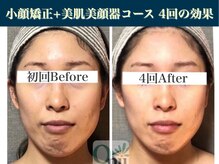 キュープ 表参道店(Qpu)/たった4回でここまで変わります