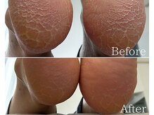 カシェット 広島店(Cachette)/50代女性☆足裏角質ケア90分