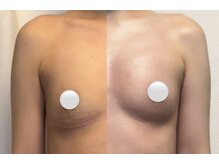 キレイバスト(Kireiii Bust)/施術イメージ