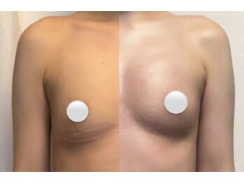 キレイバスト(Kireiii Bust)/施術イメージ