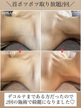 アンリミット(Unlimit)/首のポツポツが無くなると若返る