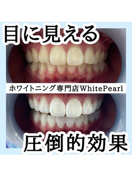 ホワイトパール 前橋(WhitePearl)/【ビフォーアフター】