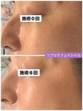 プリュネル(Prunelle)/プラズマシャワー