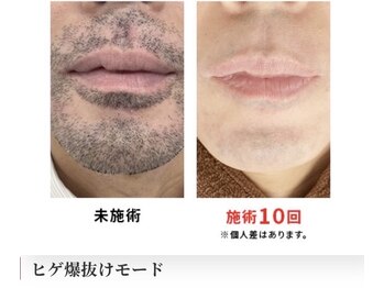 サロン ド ヤマト/ヒゲ脱毛(Before/After)