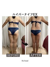 リヘッド(Re.head)/ハイパーナイフEXでくびれ爆誕