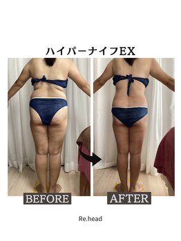 リヘッド(Re.head)/ハイパーナイフEXでくびれ爆誕
