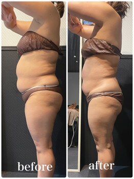 ピーラトゥ 日立(P-Ratu)/脂肪冷却◆