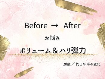 ロットプラス(Lot Plus)/バストアップ症例【B→Fカップ】