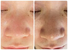 ラヴィ(Ravi)/毛穴撃退