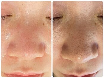 ラヴィ(Ravi)/毛穴撃退