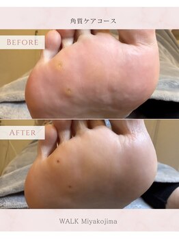 ポドウオーク(PODO WALK)/魚の目/ビフォーアフター