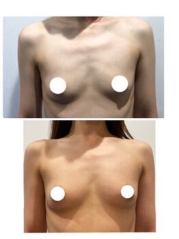 美人バスト 渋谷店/【バストアップ☆育乳】◇症例◇
