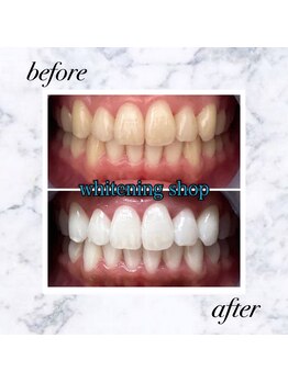 ホワイトニングショップ 岡山店/【岡山】美白ホワイトニング
