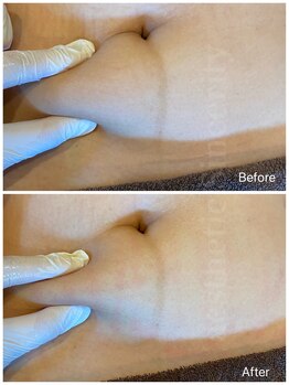 エステ シンセリティー(aesthetic sincerity)/レモンボトル脂肪分解