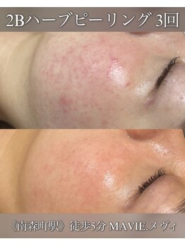 サロン ド メヴィ(SALON DE MAVIE)/【赤みケア】