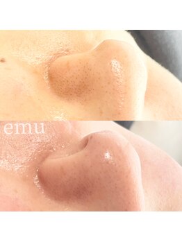 エミュ(emu)/いちご鼻、原因は毛かも?!