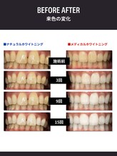 セルフダック 京都長岡京店/ホワイトニングの種類